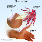 Ringworm treatment
